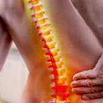 lumbar radiculopathy